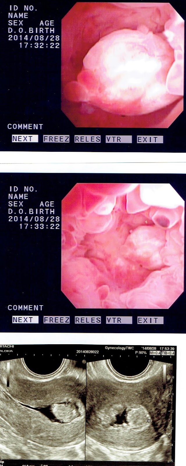 ブログ 膜 子宮 手術 内 ポリープ